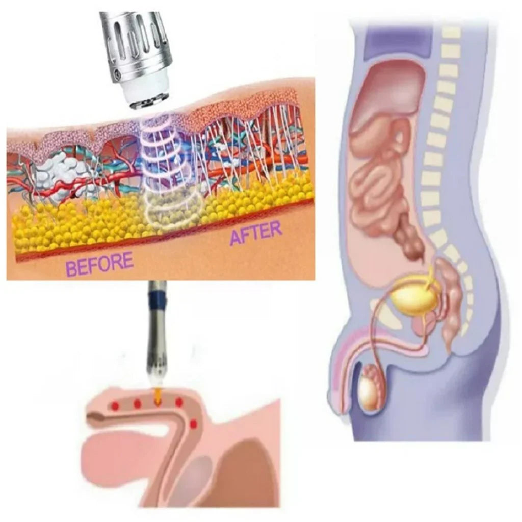 VitaPulse Compact ED Shockwave Therapy Device For Men | Petprovac