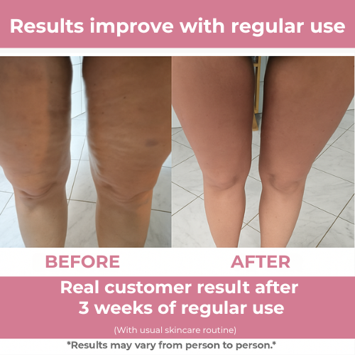 FirmFlex Pro Triple Action Skin Tightening Roller For Smoother Skin
