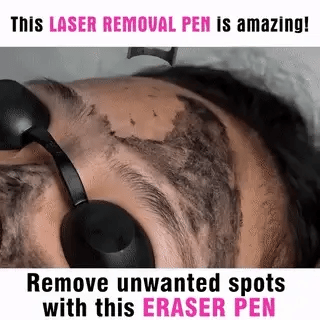 LumiDerm Hjemme Laser Pen til Fjernelse af Tatoveringer, Modermærker og Frækler